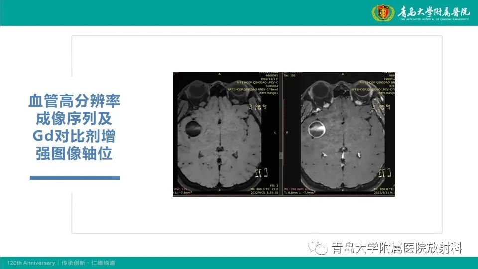 影像PPT - 【病例】颅内巨大动脉瘤1例CT及MR-7