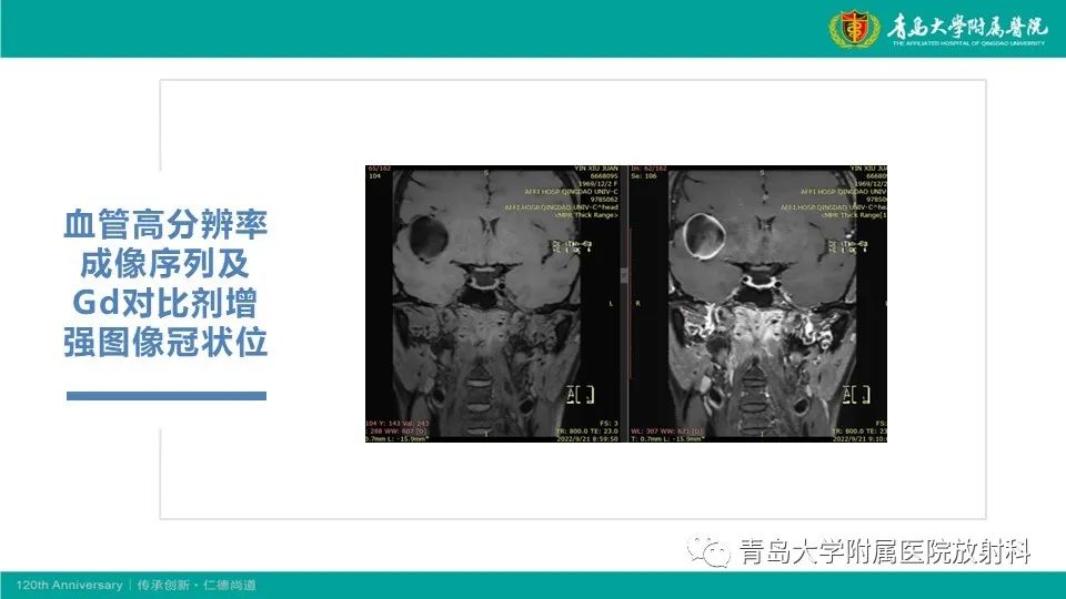 影像PPT - 【病例】颅内巨大动脉瘤1例CT及MR-8
