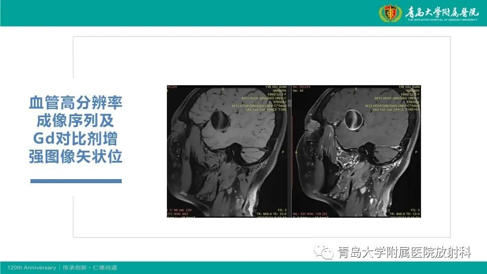 影像PPT - 【病例】颅内巨大动脉瘤1例CT及MR-9
