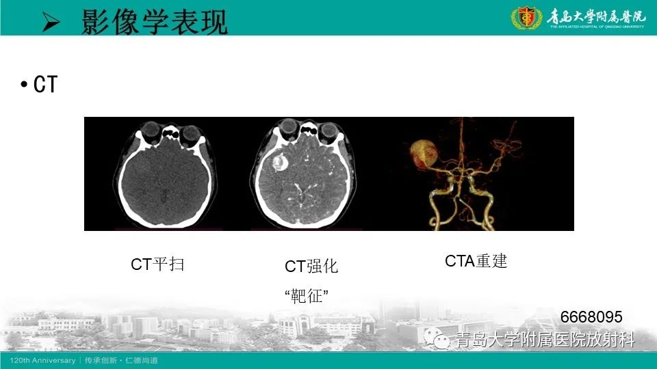 影像PPT - 【病例】颅内巨大动脉瘤1例CT及MR-19