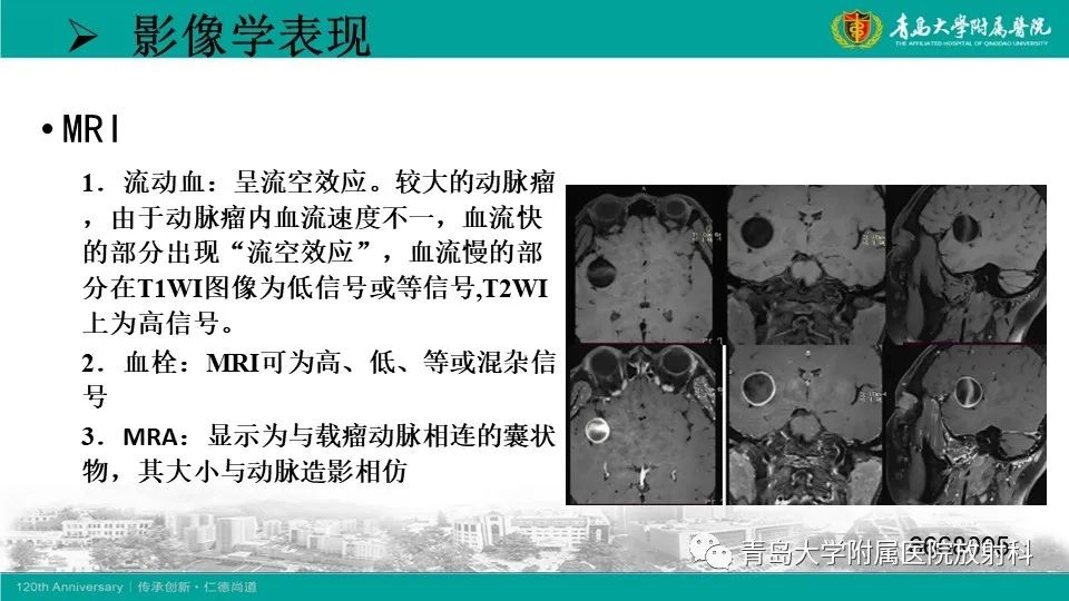 影像PPT - 【病例】颅内巨大动脉瘤1例CT及MR-20