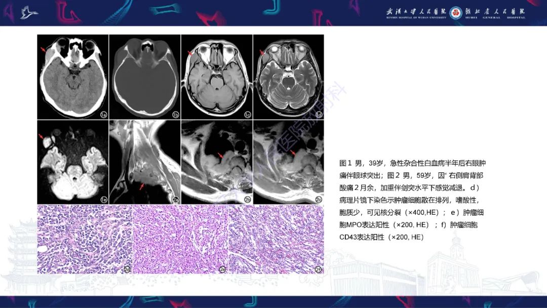 影像PPT - 【PPT】阴道髓系肉瘤影像诊断-15