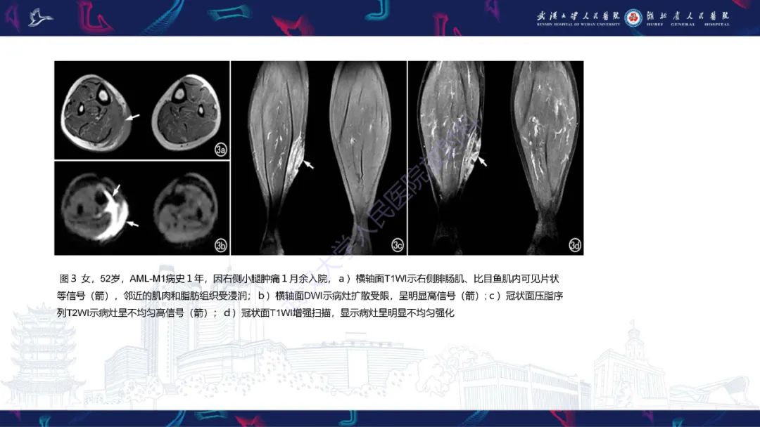影像PPT - 【PPT】阴道髓系肉瘤影像诊断-16