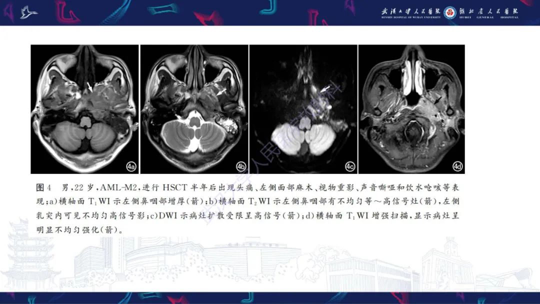 影像PPT - 【PPT】阴道髓系肉瘤影像诊断-17