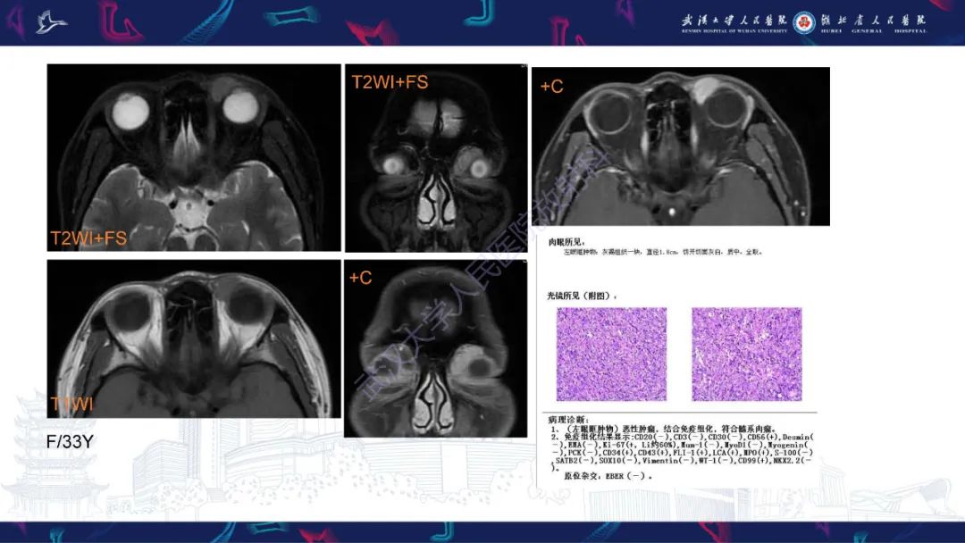 影像PPT - 【PPT】阴道髓系肉瘤影像诊断-20