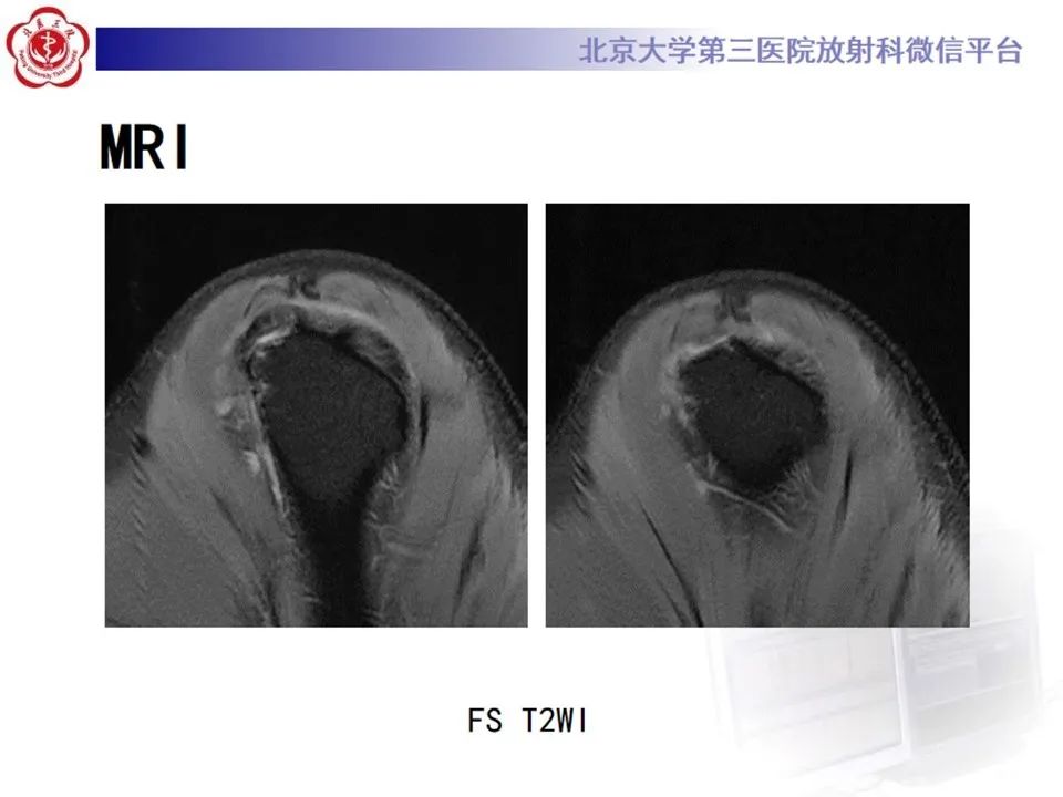 影像PPT - 【PPT】肩袖部分撕裂-4