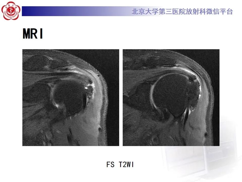 影像PPT - 【PPT】肩袖部分撕裂-3