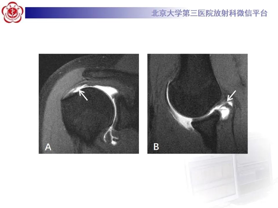 影像PPT - 【PPT】肩袖部分撕裂-16