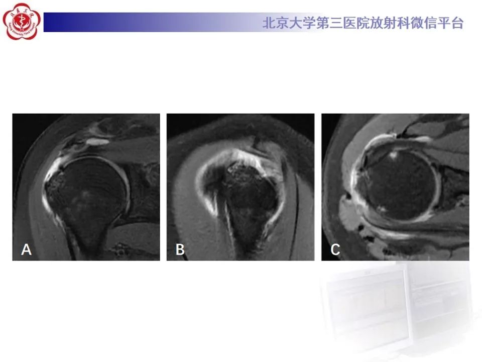 影像PPT - 【PPT】肩袖部分撕裂-19