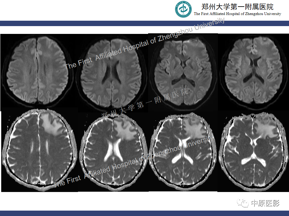 影像PPT - 【病例】神经梅毒1例MR影像-5