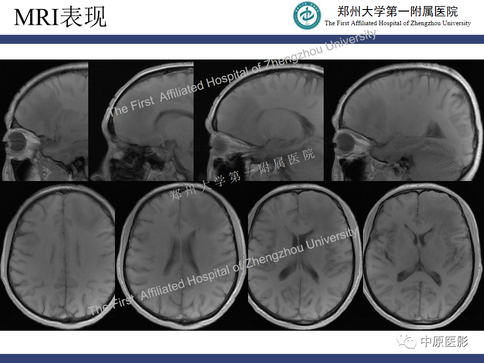 影像PPT - 【病例】神经梅毒1例MR影像-3