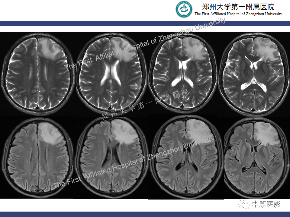 影像PPT - 【病例】神经梅毒1例MR影像-4