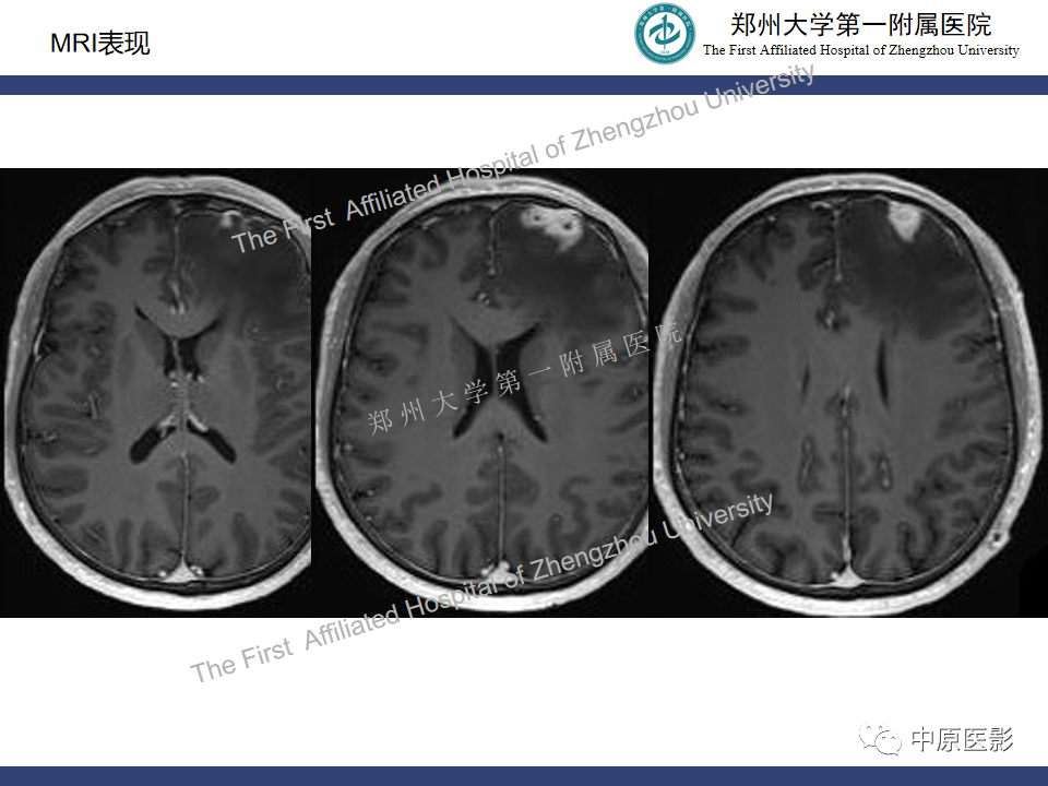 影像PPT - 【病例】神经梅毒1例MR影像-6