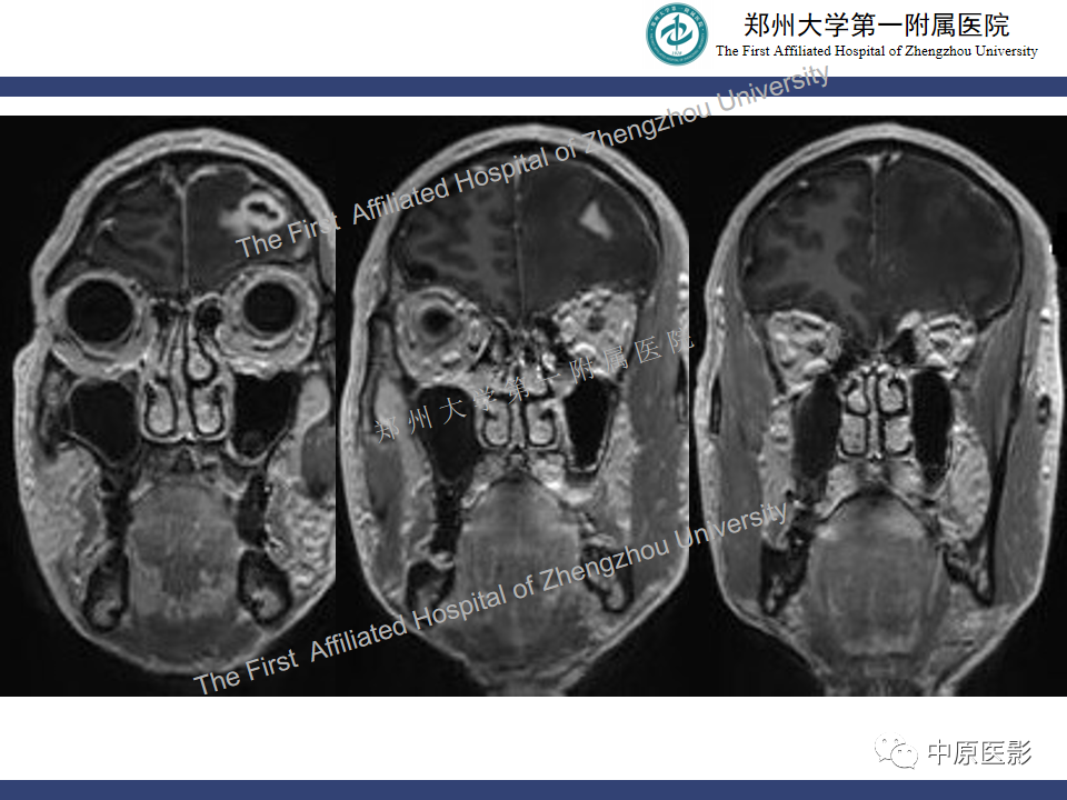 影像PPT - 【病例】神经梅毒1例MR影像-7