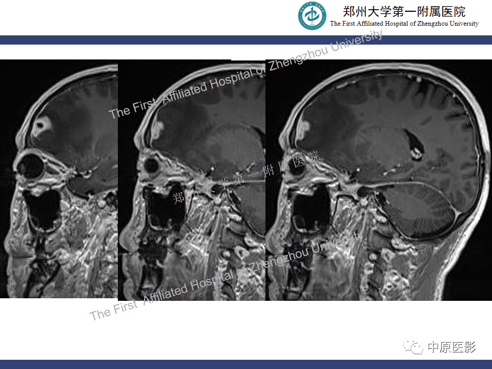影像PPT - 【病例】神经梅毒1例MR影像-8