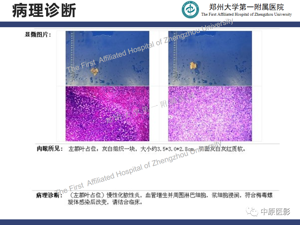 影像PPT - 【病例】神经梅毒1例MR影像-12