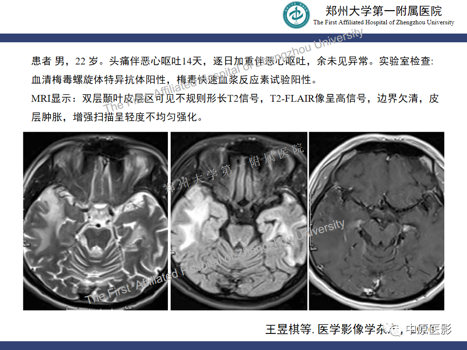影像PPT - 【病例】神经梅毒1例MR影像-21