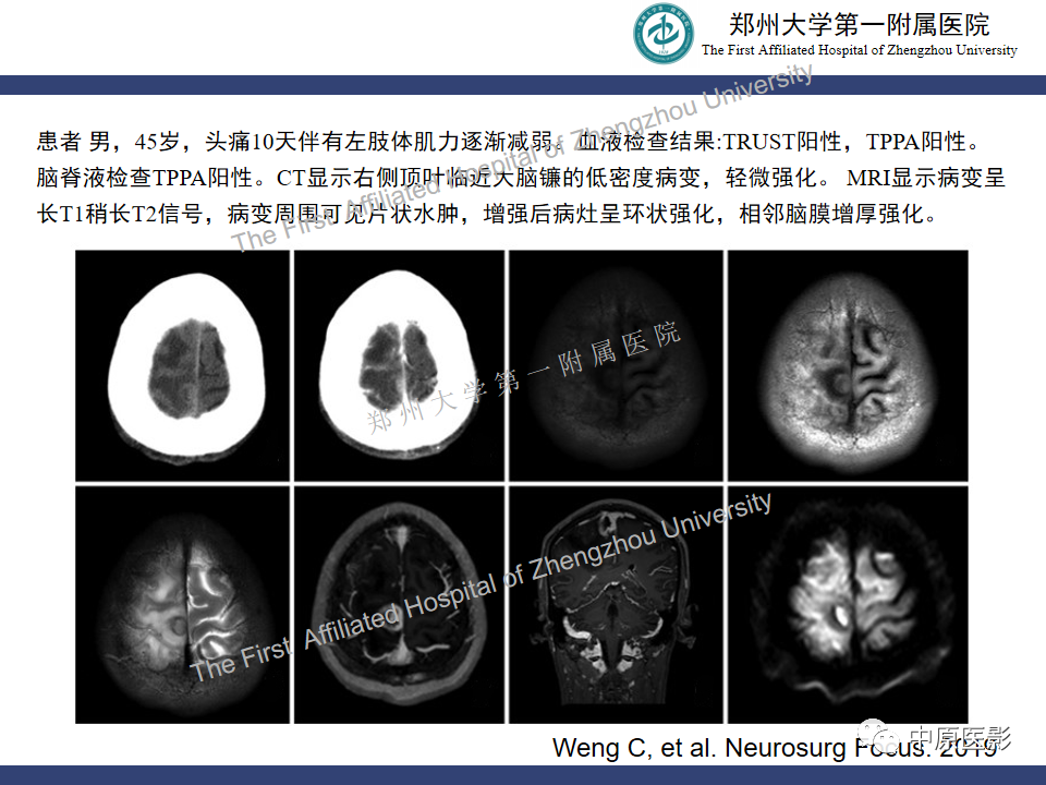 影像PPT - 【病例】神经梅毒1例MR影像-22