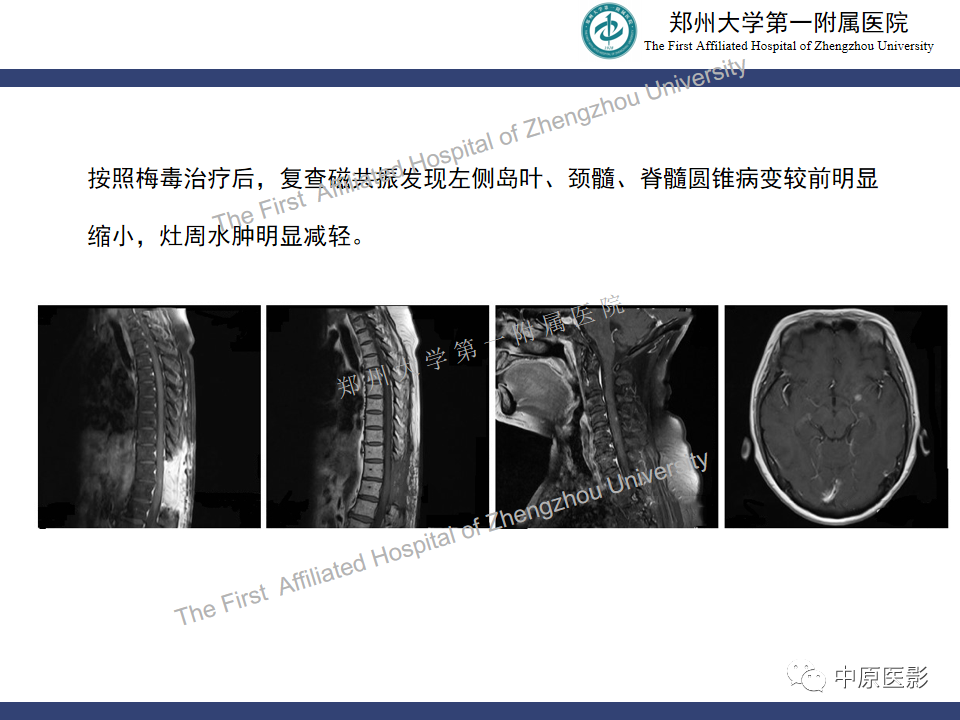 影像PPT - 【病例】神经梅毒1例MR影像-25
