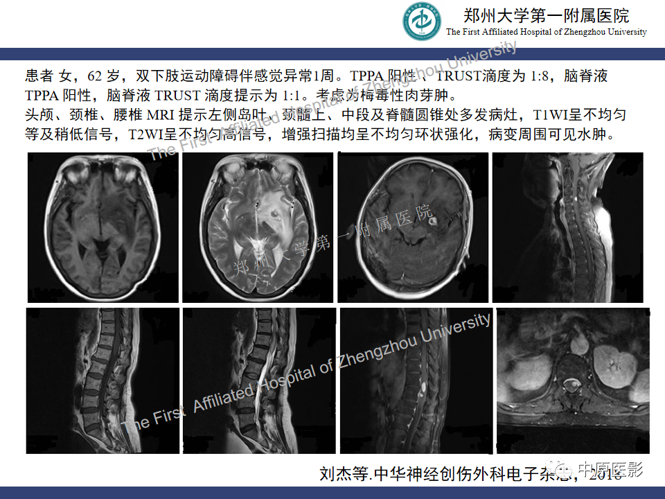 影像PPT - 【病例】神经梅毒1例MR影像-24