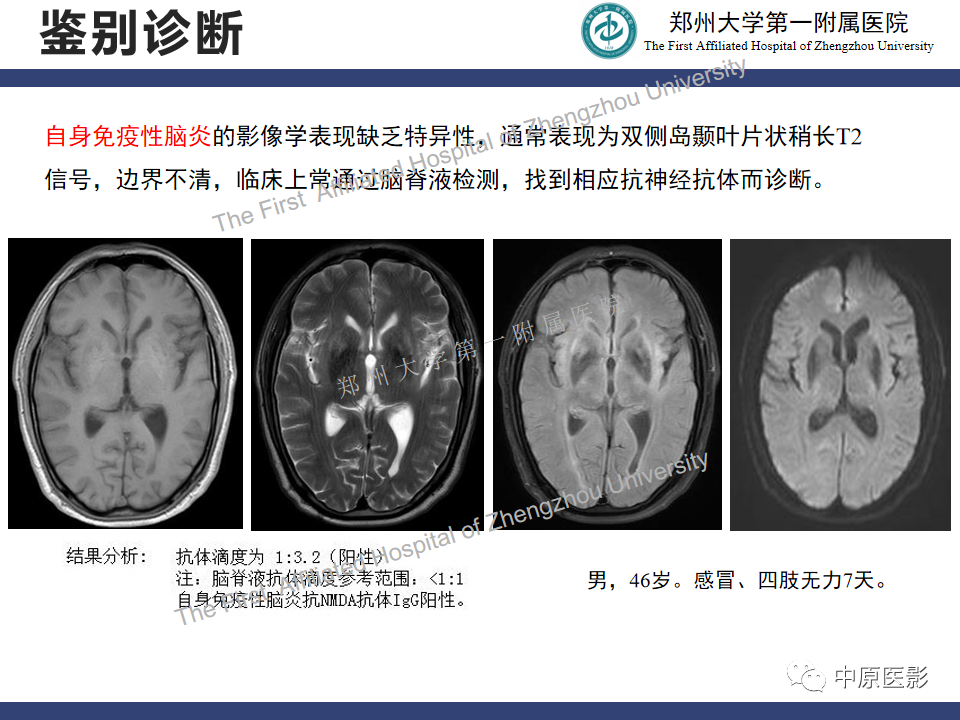 影像PPT - 【病例】神经梅毒1例MR影像-27