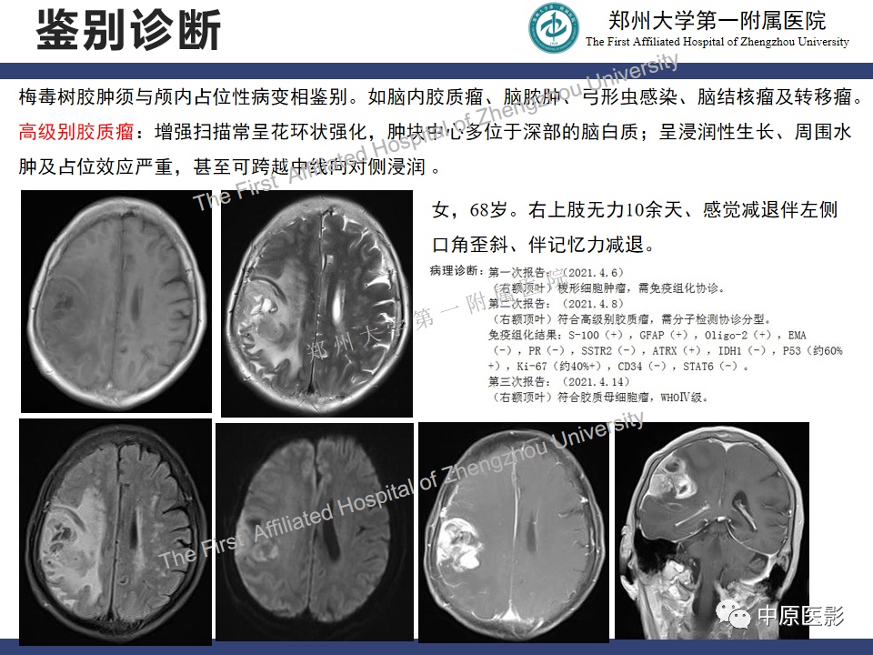 影像PPT - 【病例】神经梅毒1例MR影像-28