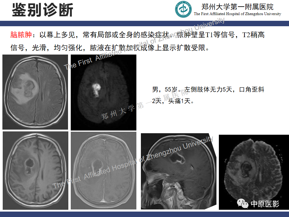 影像PPT - 【病例】神经梅毒1例MR影像-29