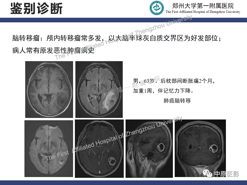 影像PPT - 【病例】神经梅毒1例MR影像-30