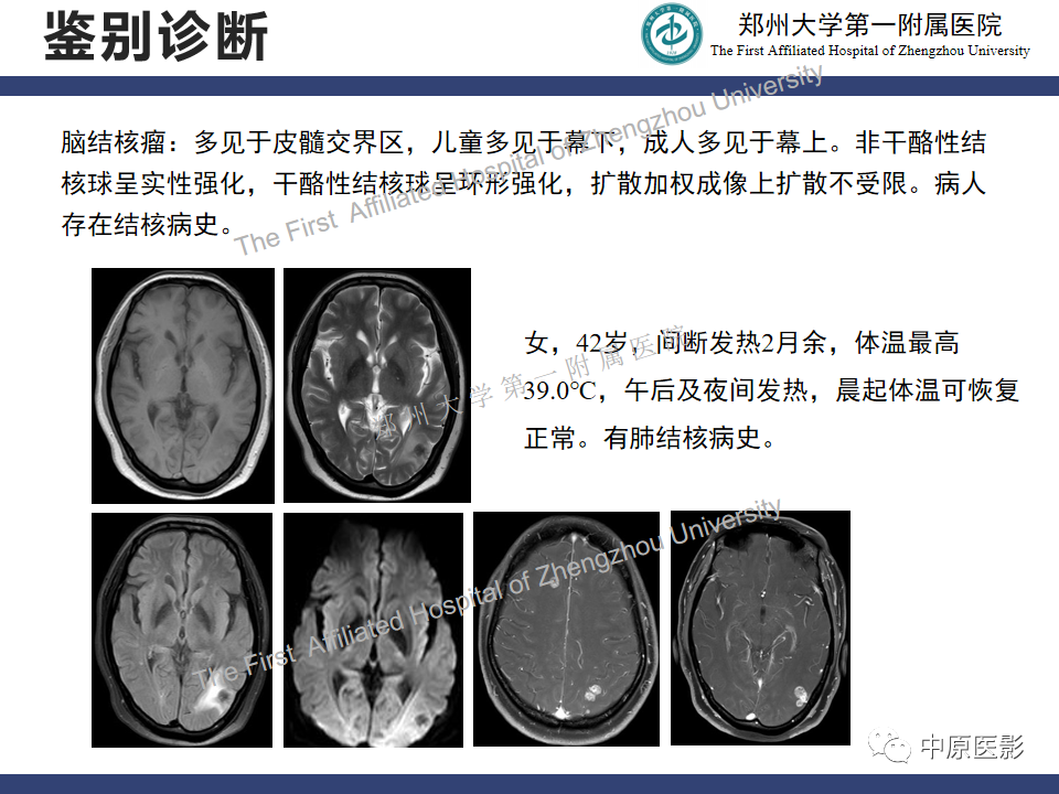 影像PPT - 【病例】神经梅毒1例MR影像-31