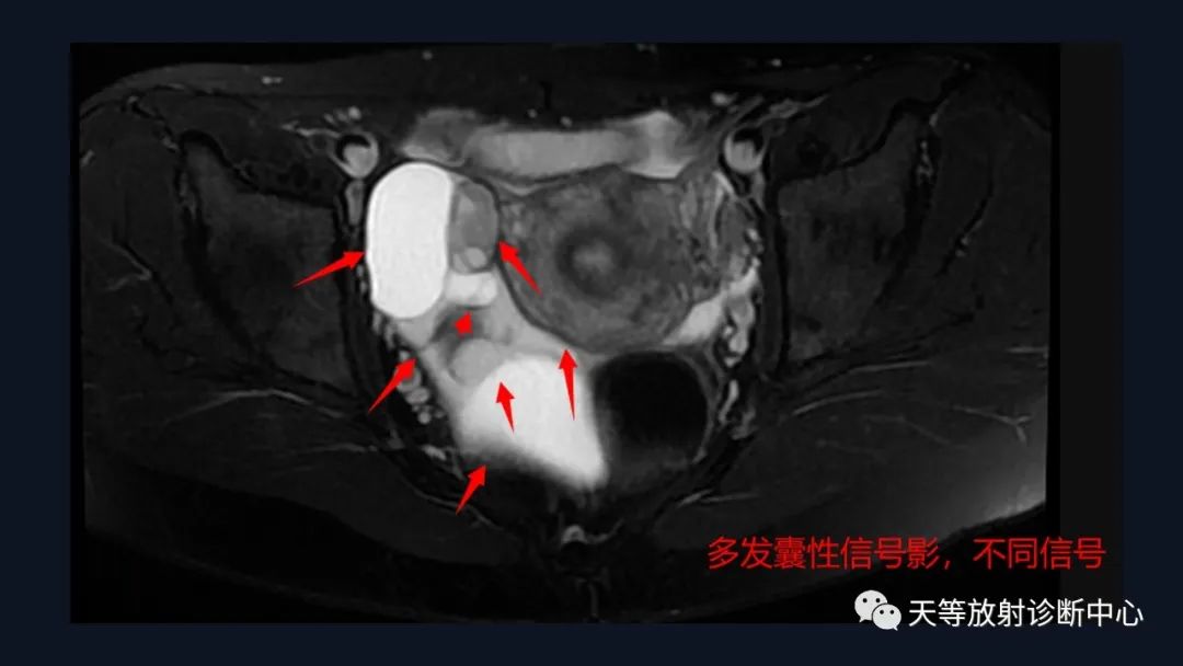 影像PPT - 【病例】中肾管囊肿/卵巢冠囊肿1例MR影像-7 影像PPT - 【病例】中肾管囊肿/卵巢冠囊肿1例MR影像-7