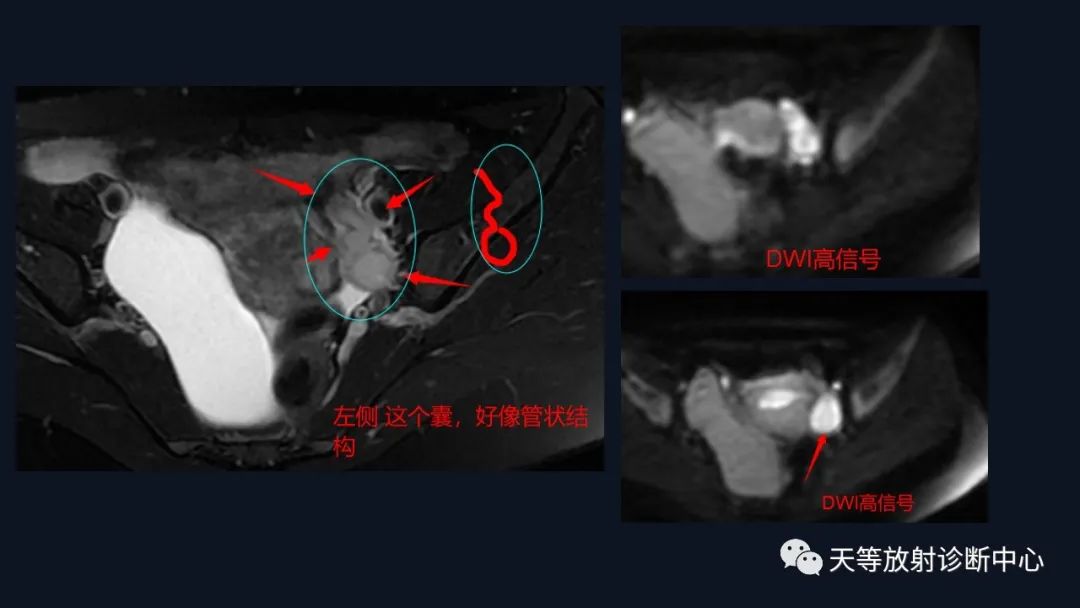 影像PPT - 【病例】中肾管囊肿/卵巢冠囊肿1例MR影像-8 影像PPT - 【病例】中肾管囊肿/卵巢冠囊肿1例MR影像-8