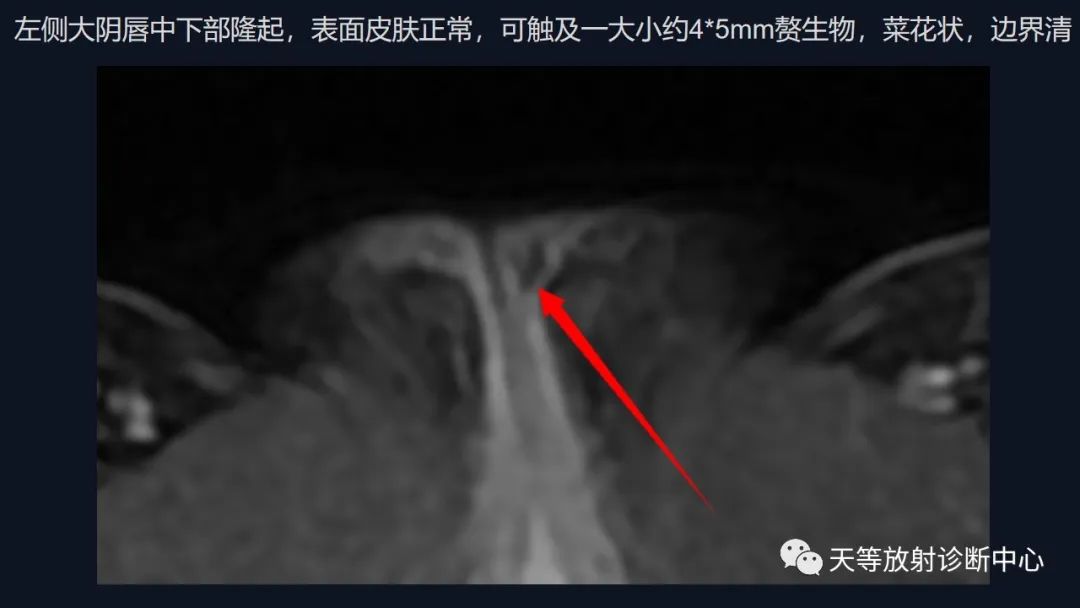 影像PPT - 【病例】中肾管囊肿/卵巢冠囊肿1例MR影像-19 影像PPT - 【病例】中肾管囊肿/卵巢冠囊肿1例MR影像-19