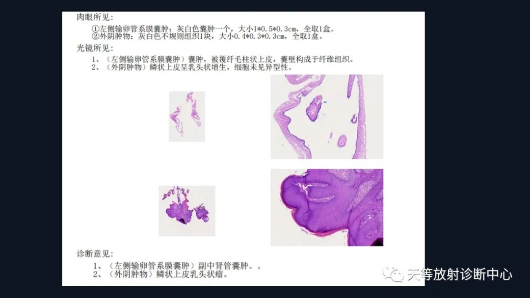 影像PPT - 【病例】中肾管囊肿/卵巢冠囊肿1例MR影像-20 影像PPT - 【病例】中肾管囊肿/卵巢冠囊肿1例MR影像-20