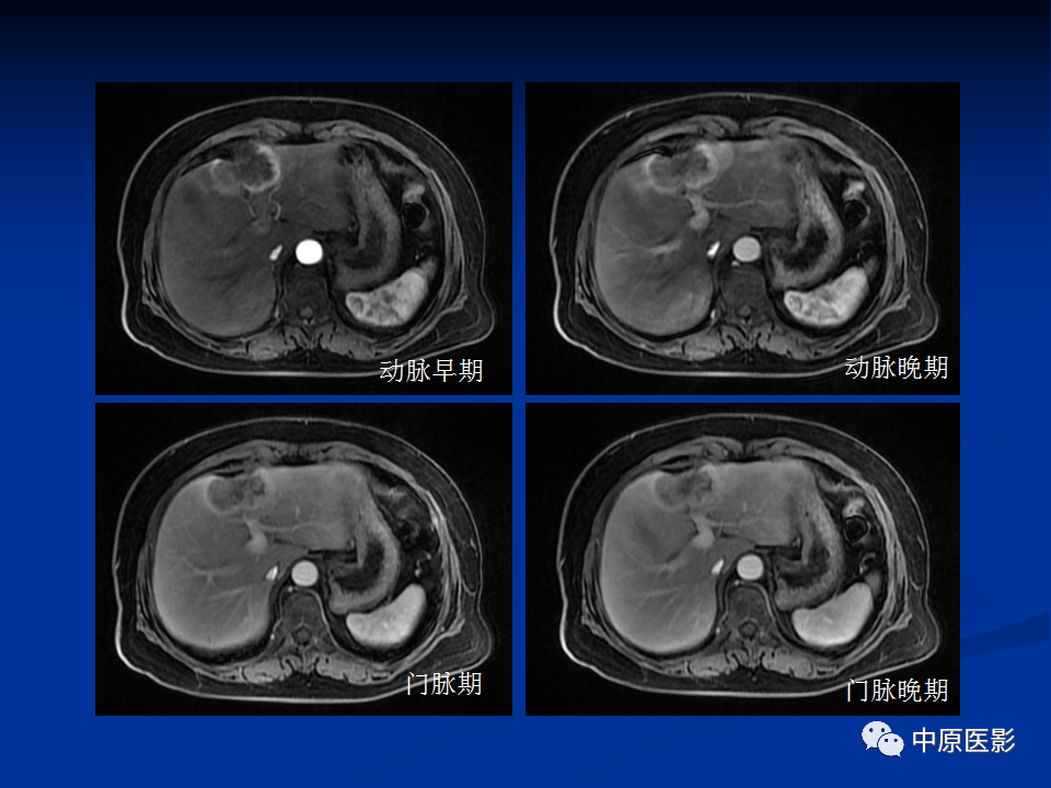 影像PPT - 【病例】肝脏胆管细胞癌1例MR影像-7