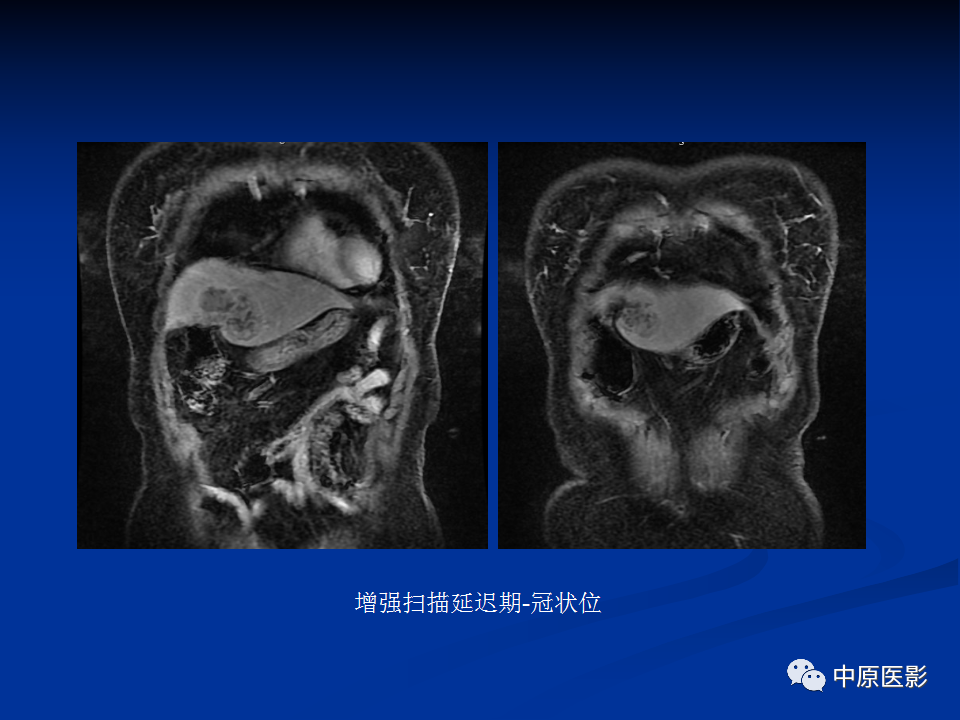 影像PPT - 【病例】肝脏胆管细胞癌1例MR影像-8