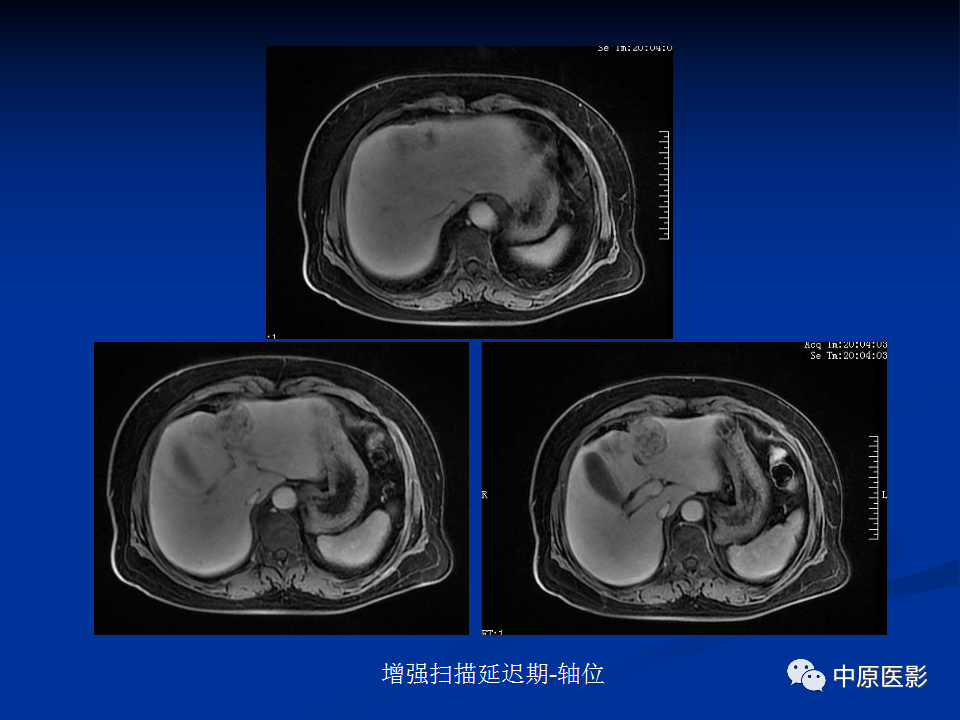 影像PPT - 【病例】肝脏胆管细胞癌1例MR影像-9