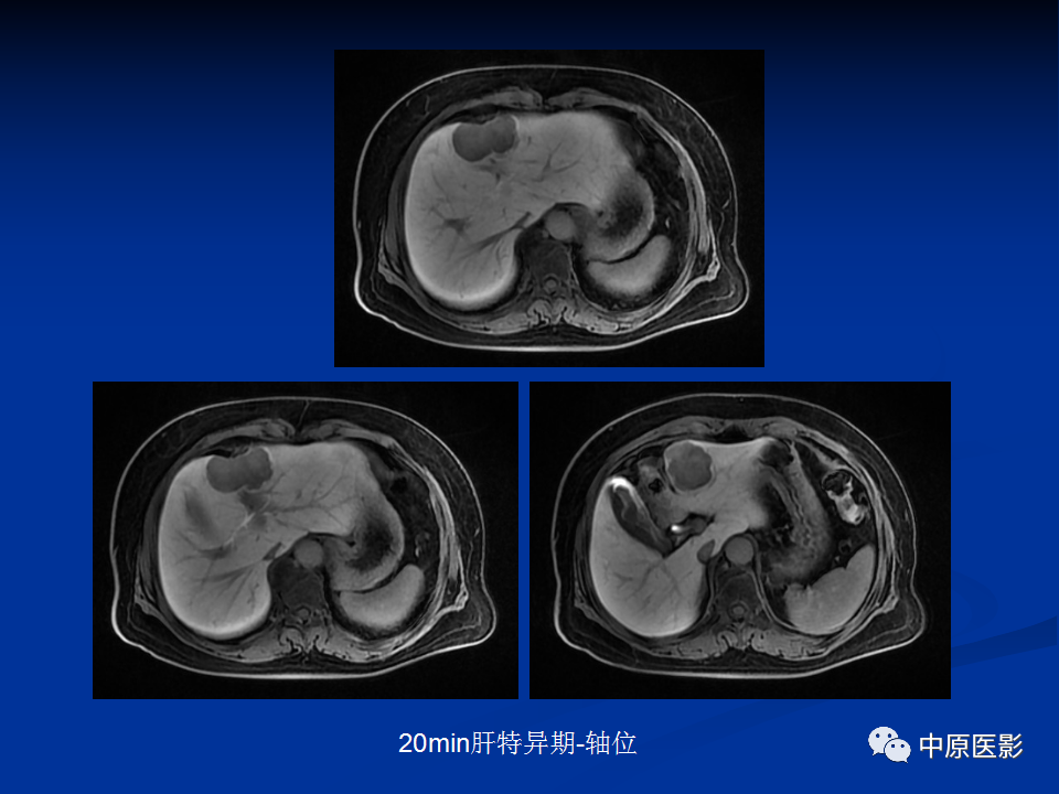 影像PPT - 【病例】肝脏胆管细胞癌1例MR影像-10