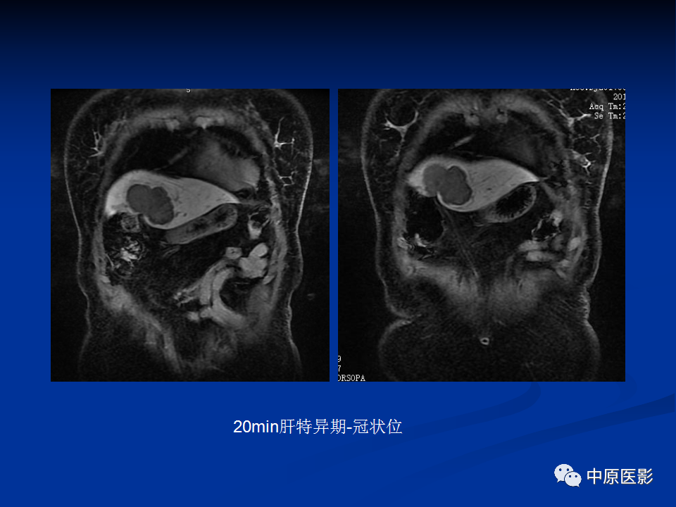 影像PPT - 【病例】肝脏胆管细胞癌1例MR影像-11