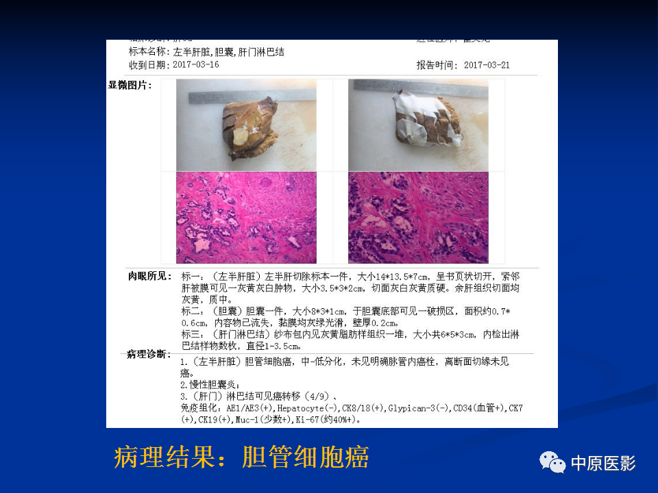 影像PPT - 【病例】肝脏胆管细胞癌1例MR影像-14