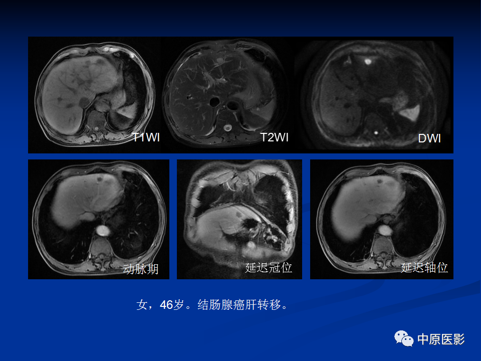 影像PPT - 【病例】肝脏胆管细胞癌1例MR影像-19