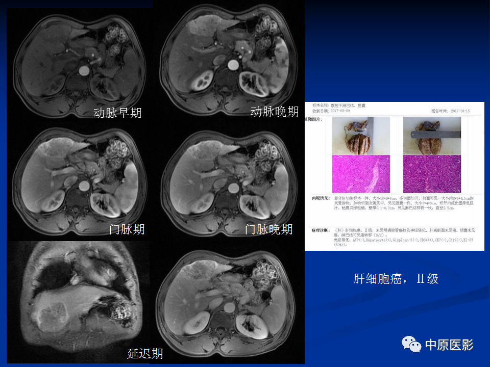 影像PPT - 【病例】肝脏胆管细胞癌1例MR影像-22