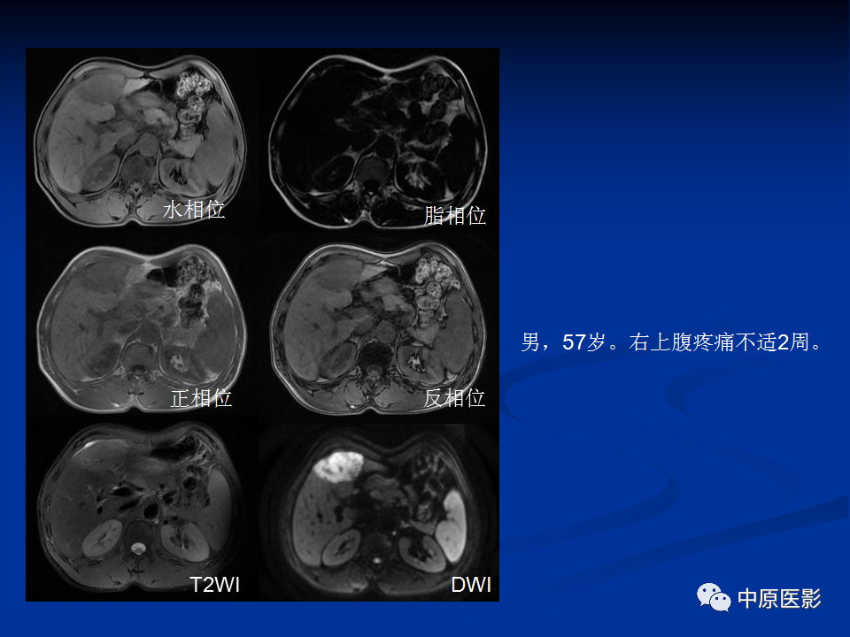影像PPT - 【病例】肝脏胆管细胞癌1例MR影像-21
