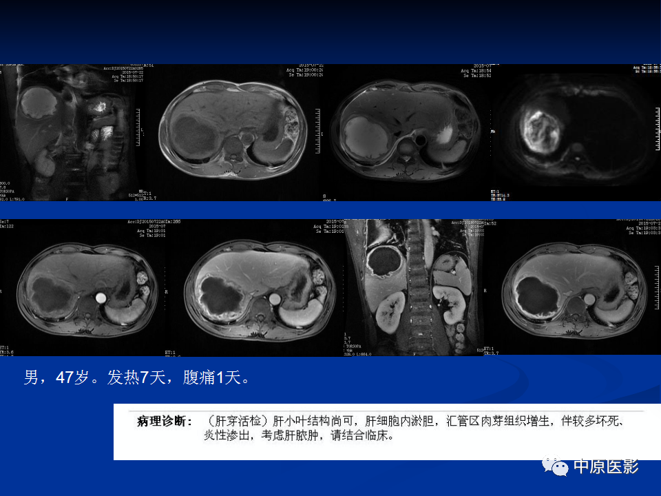 影像PPT - 【病例】肝脏胆管细胞癌1例MR影像-24
