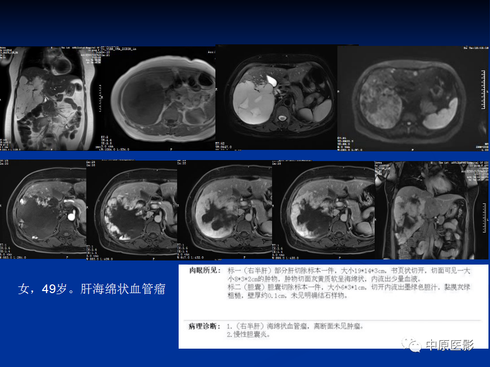 影像PPT - 【病例】肝脏胆管细胞癌1例MR影像-26