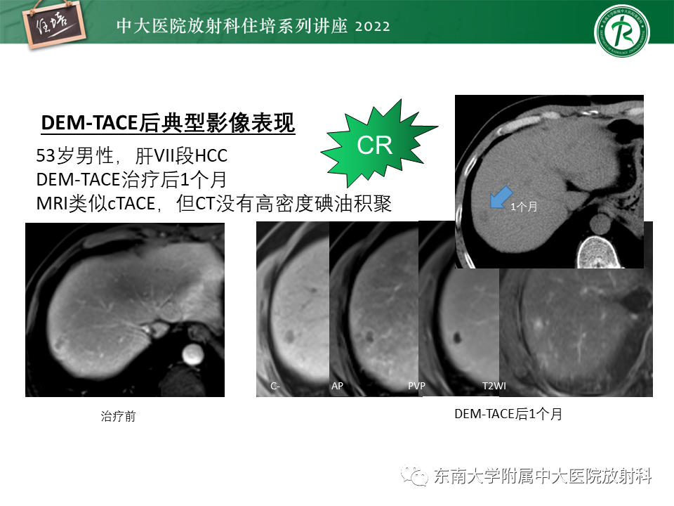 影像PPT - 【PPT】肝癌介入治疗后的磁共振评估-8