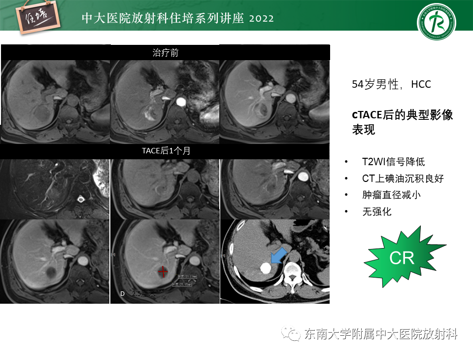 影像PPT - 【PPT】肝癌介入治疗后的磁共振评估-7