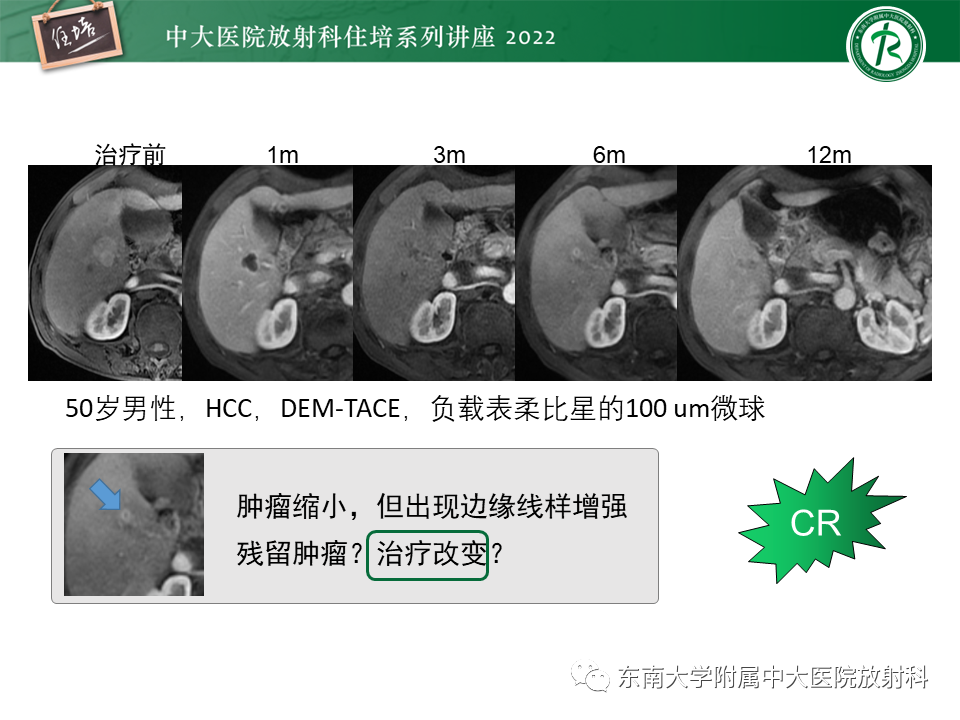 影像PPT - 【PPT】肝癌介入治疗后的磁共振评估-9