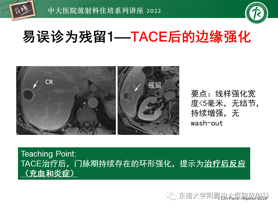 影像PPT - 【PPT】肝癌介入治疗后的磁共振评估-10