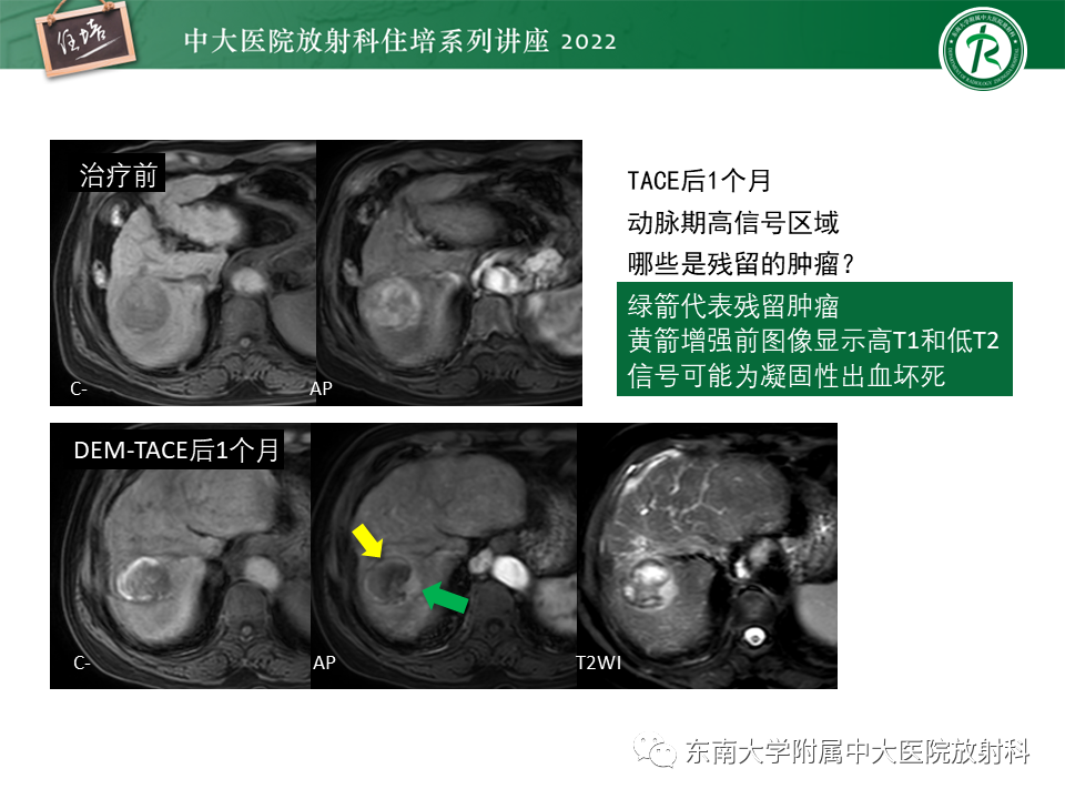影像PPT - 【PPT】肝癌介入治疗后的磁共振评估-11