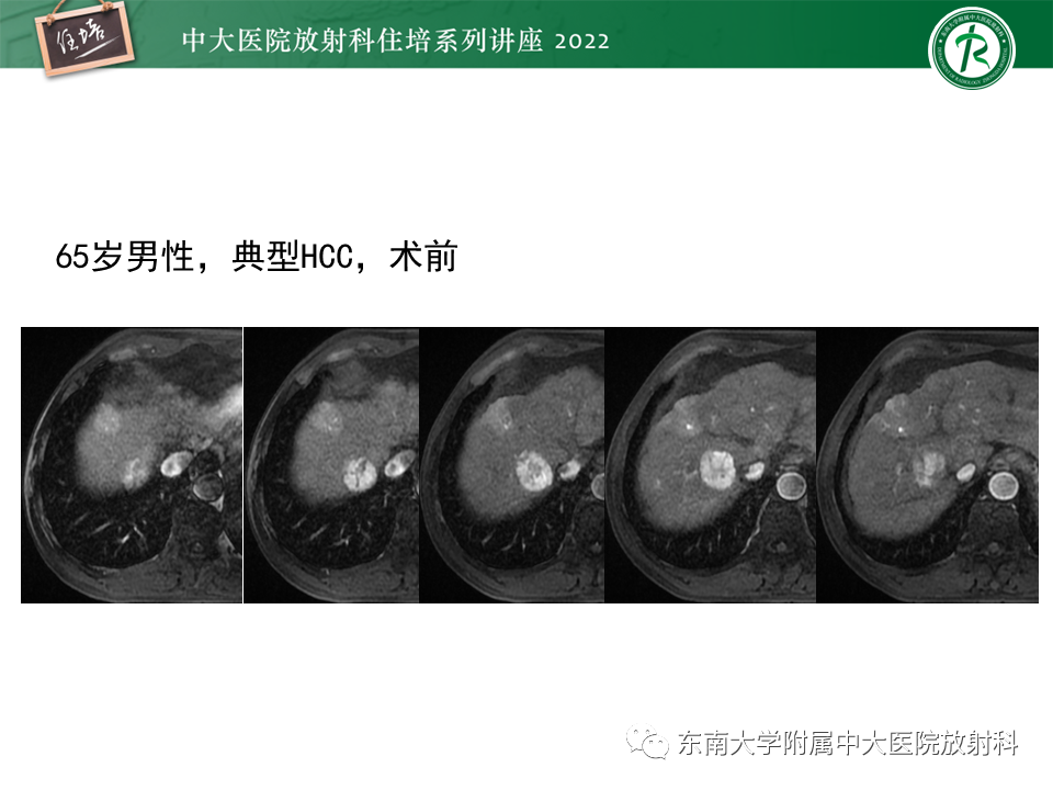 影像PPT - 【PPT】肝癌介入治疗后的磁共振评估-14